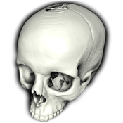Human Skull: Volume rendering of a human skull using volumetric halos